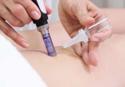 Estrias dermapen Salamanca