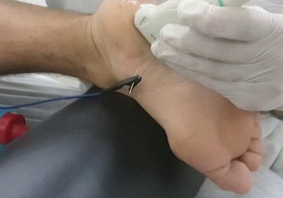 fascitis plantar salamanca